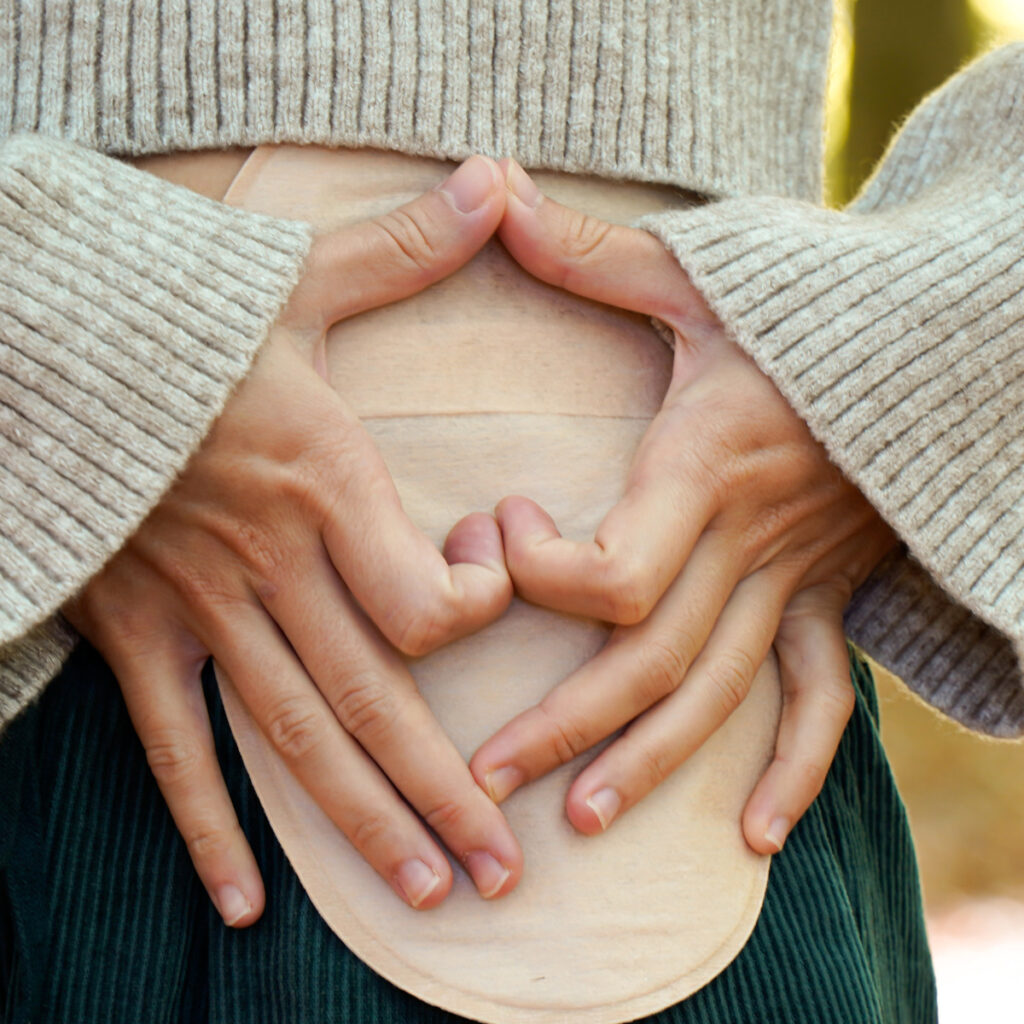 A Burtonsville, MD patient making a heart shape with their hands over their ostomy bag.