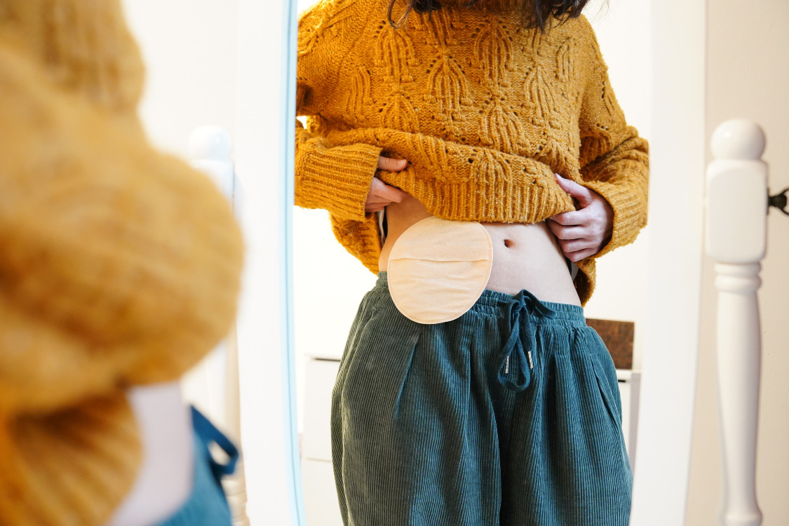 A girl lifting up her sweater to show her ostomy bag.